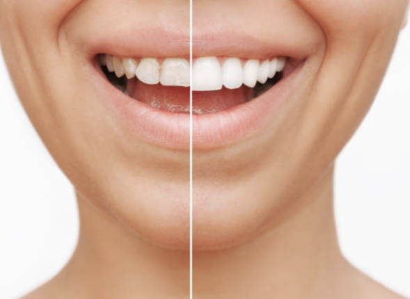 Veneer